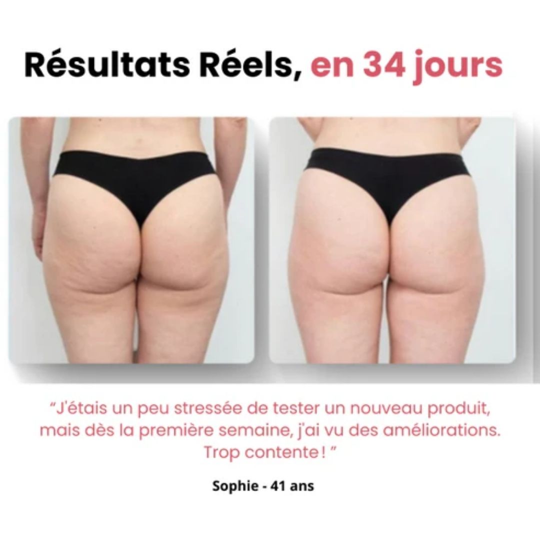 Purly™ - Masseur Anti-Cellulite