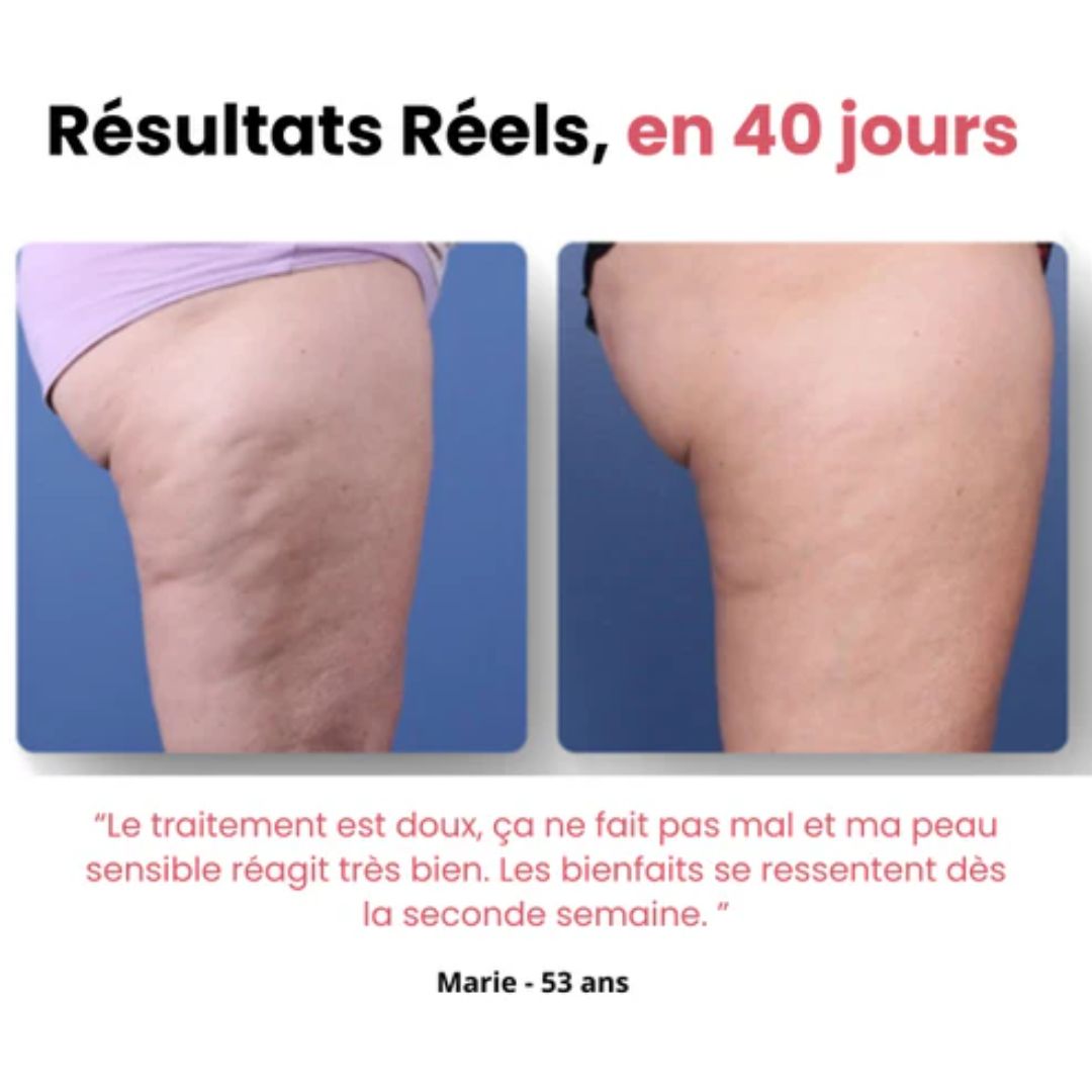 Purly™ - Masseur Anti-Cellulite