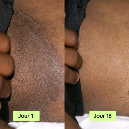 Purly™ Savon pour soulager les démangeaisons entre les cuisses