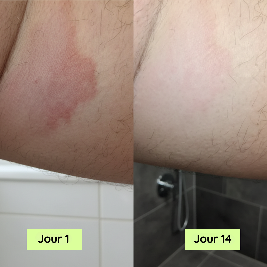 Purly™ Savon pour soulager les démangeaisons entre les cuisses