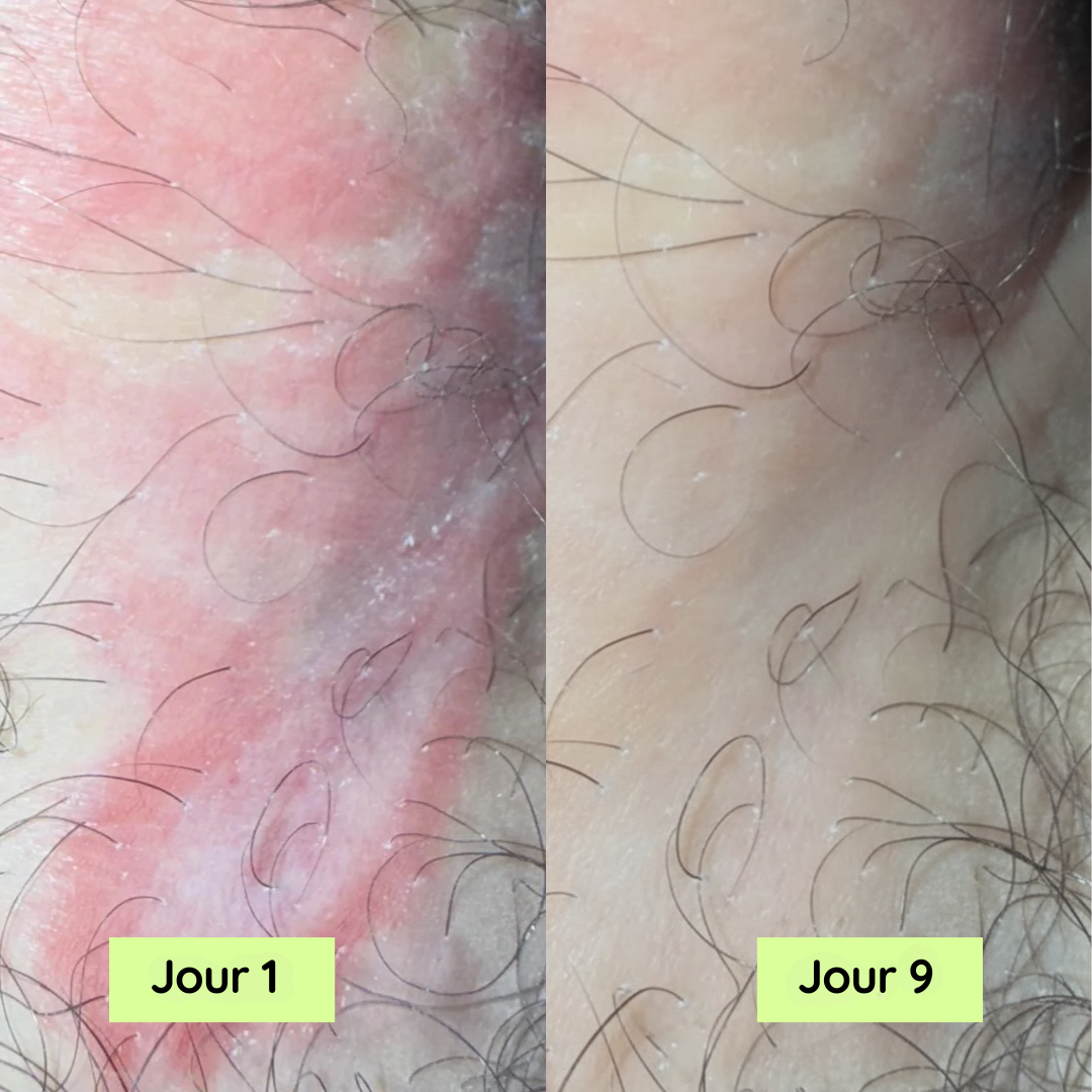 Purly™ Savon pour soulager les démangeaisons entre les cuisses